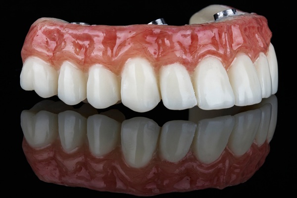 All On Dental Implants: Candidacy, Costs, And Recovery Timeline