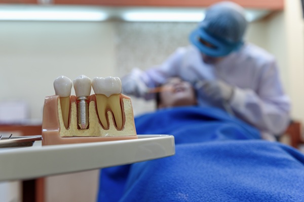 Dental Implants: A Solution For Missing Teeth